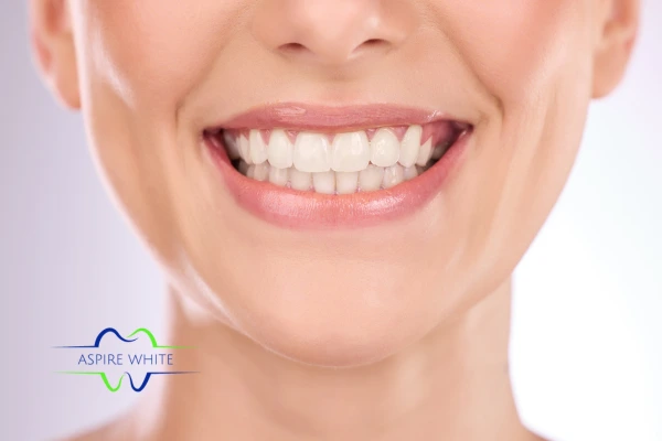 Follow your teeth whitening aftercare Luton to prolong your whiter smile!